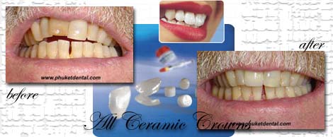 All ceramic crowns&bridges:Phuket Dentist,Thailand